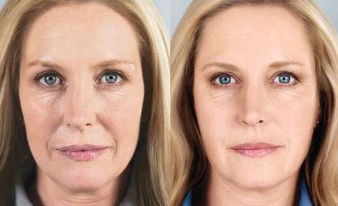 sculptra-fillers-voor-en-na